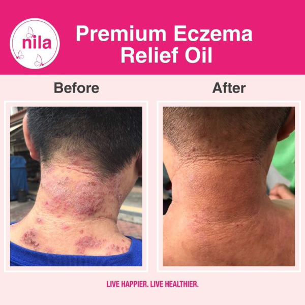 premium eczema relief oil img 3