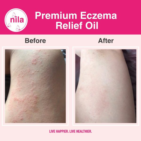 premium eczema relief oil img 4