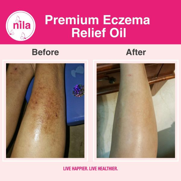 premium eczema relief oil img 5