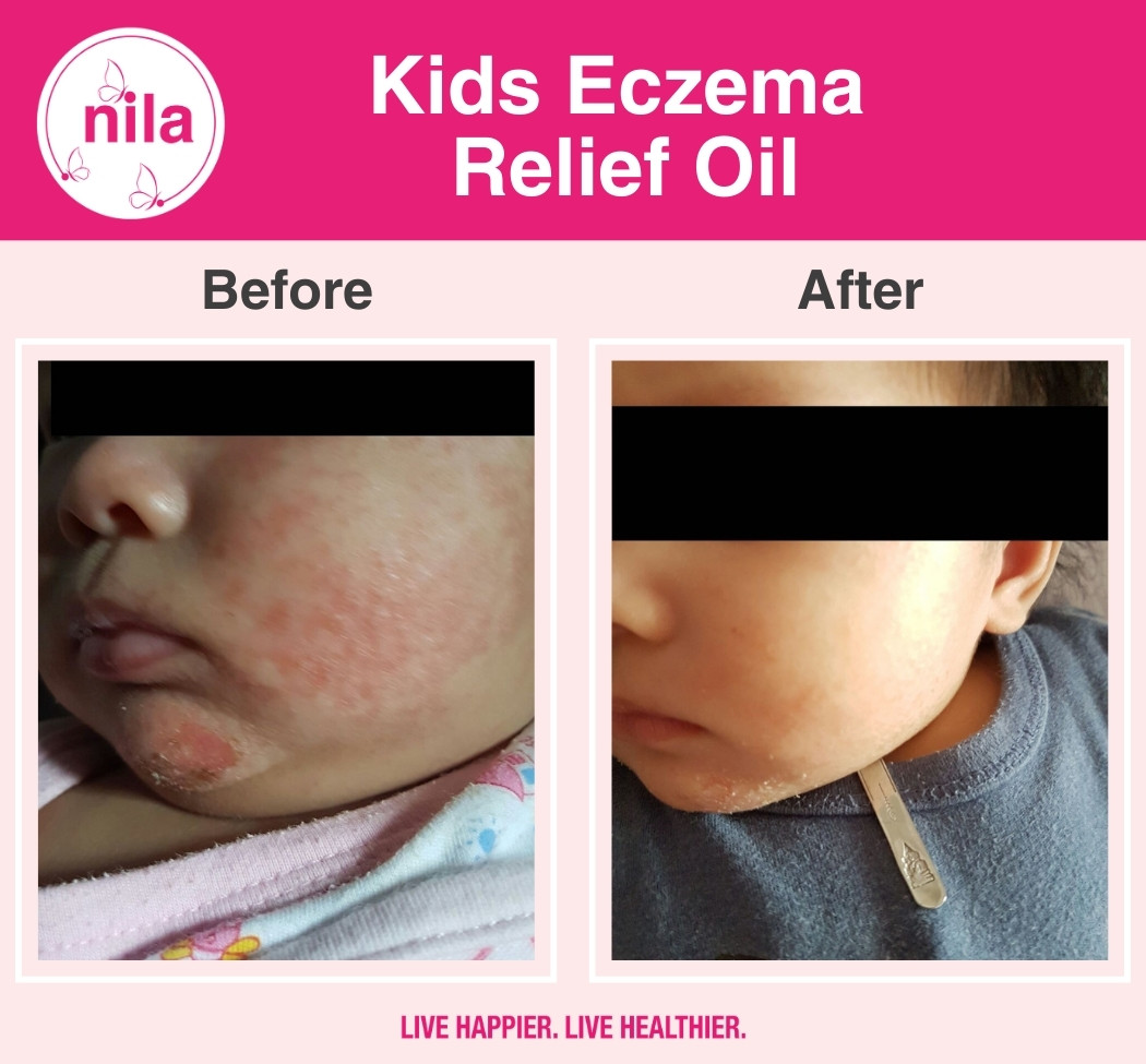 Kids-Eczema-Relief-Oil-4.jpg