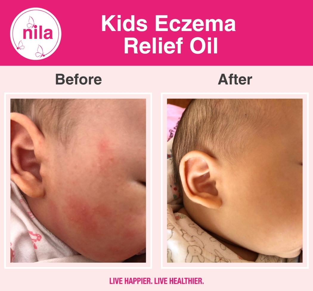 Kids-Eczema-Relief-Oil-5.jpg
